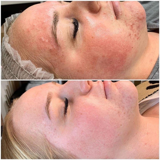 Understanding TCA Peels: The Ultimate Guide for Skin Transformation - Iconic Upgrades