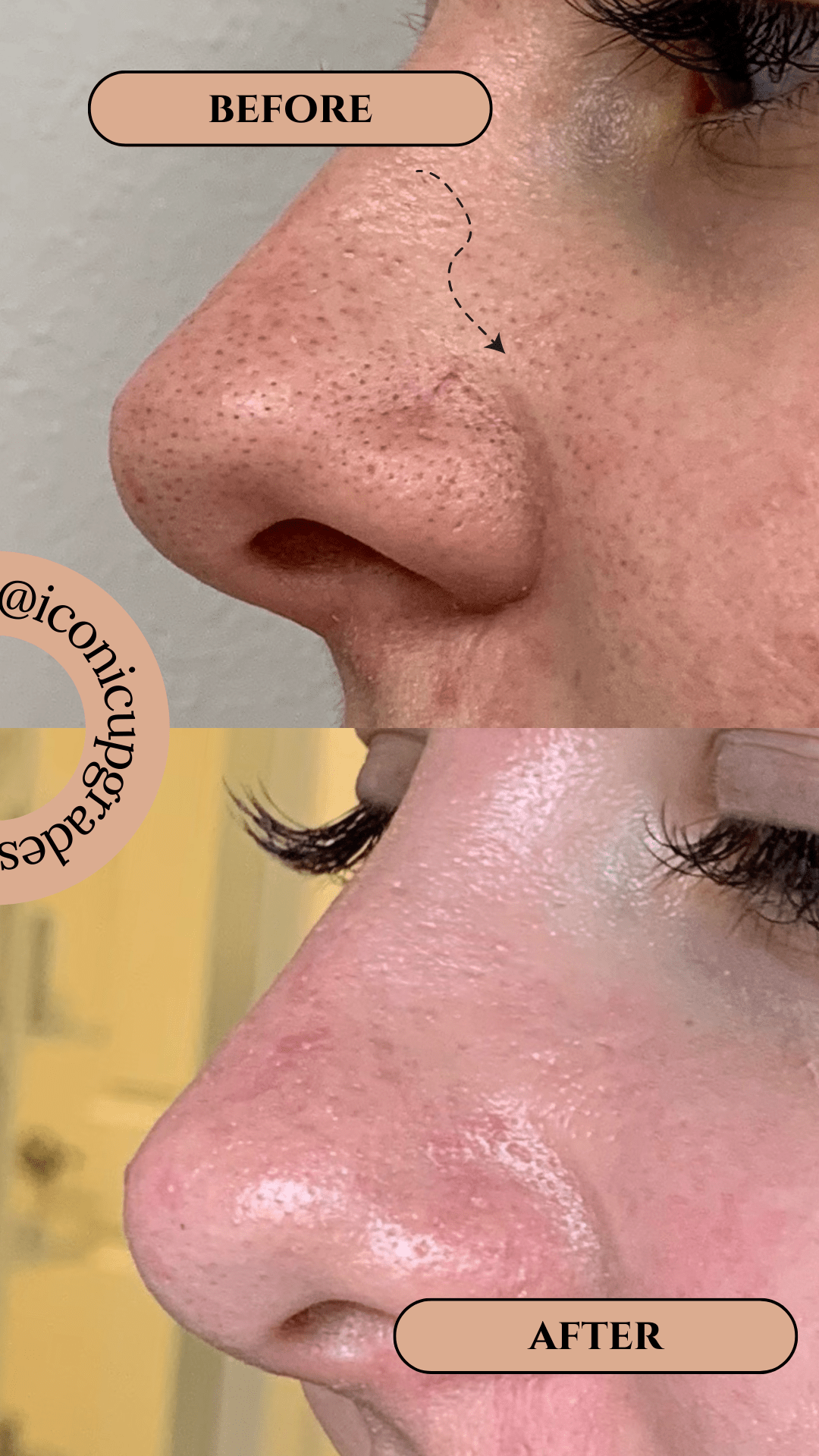 Why Traditional Facials, Microchanneling, and Chemical Peels Are Superior to Hydrafacial for Skin Health - Iconic Upgrades