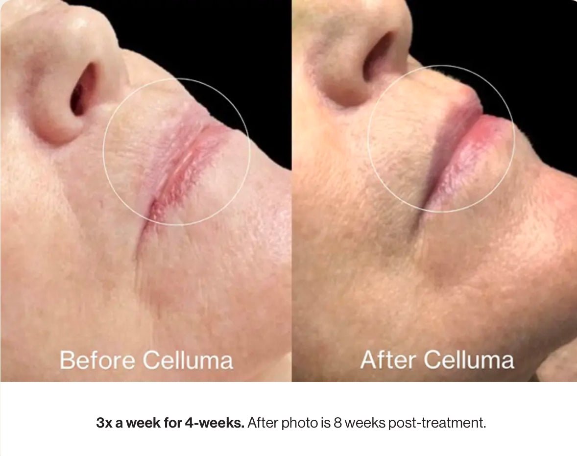 Celluma Pro - Iconic Upgrades