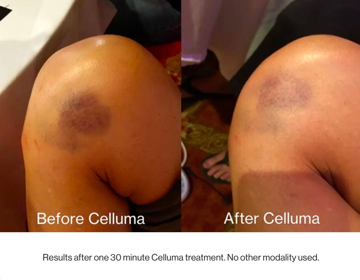 Celluma Pro - Iconic Upgrades